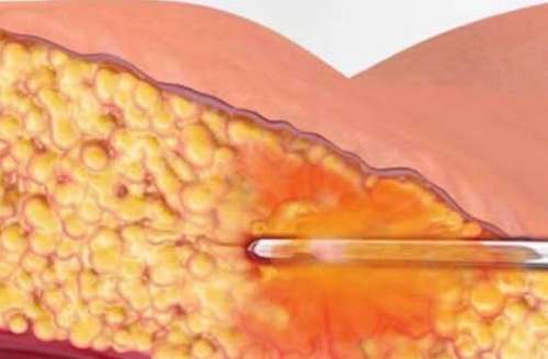 水動(dòng)力吸脂要多少錢(qián)？從3k到3w差在哪？?jī)?nèi)附真實(shí)報(bào)價(jià)表