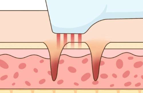 祛斑后反黑期真實(shí)照片怎么樣？過(guò)來(lái)人看看恢復(fù)情況如何